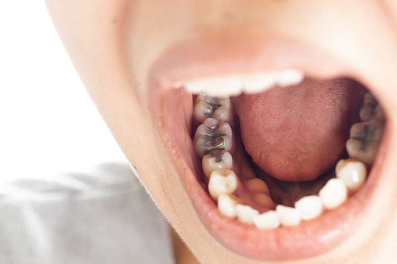 Filling, Teeth, Dental, Care, Oral, Cavity (3) Dental Issues That Can Lead to Bigger Problems